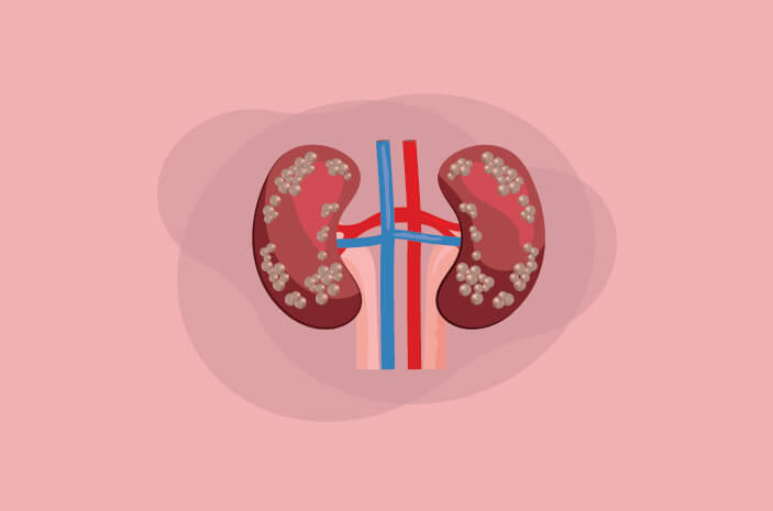 Gagal Ginjal Akut: Kenali Penurunan Fungsi Ginjal Mendadak dan Solusinya